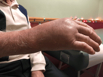 Patient receiving MLS laser therapy for pain relief at South Suburban Chiropractic Clinic.